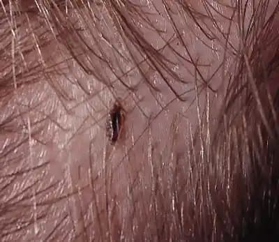 Saç Neden Bitlenir ve Bitlenmeyle Mücadele Yöntemleri Hakkında Kapsamlı Bilgi