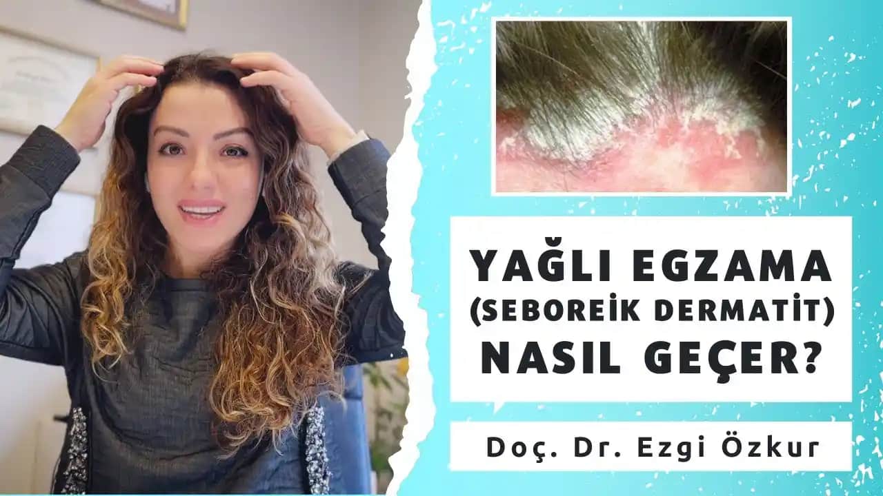 Saç Yağlı Egzama Nedir, Belirtileri ve Doğru Bakım Yöntemleri Hakkında Bilgiler