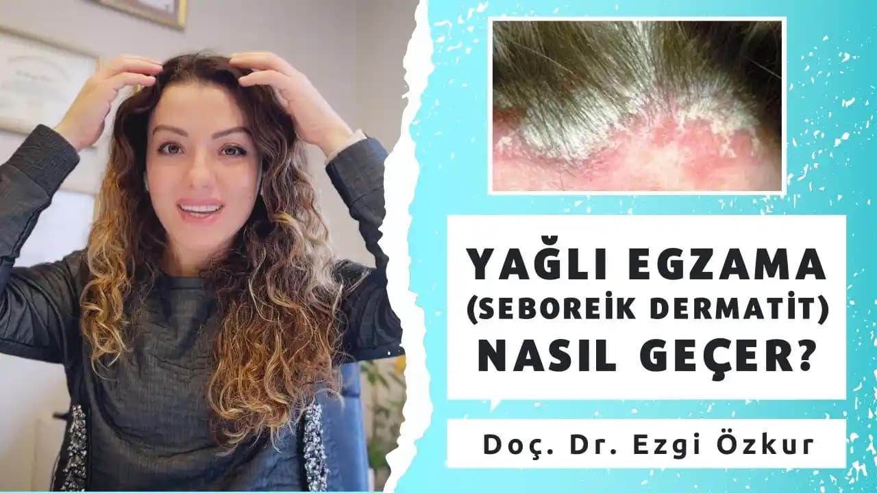 Saç Yağlı Egzama Nedir, Belirtileri ve Doğru Bakım Yöntemleri Hakkında Bilgiler