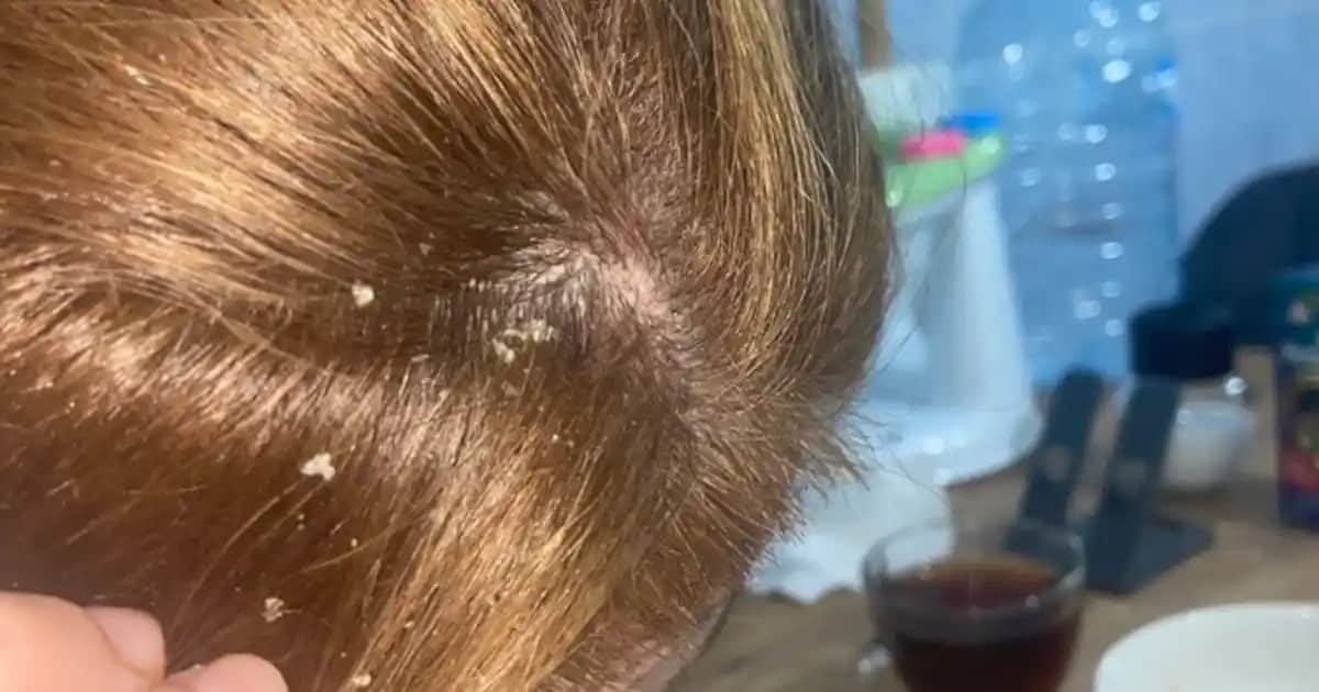 Saçımdan Beyaz Şeyler Dökülmesi Nedenleri ve Etkili Çözüm Yolları