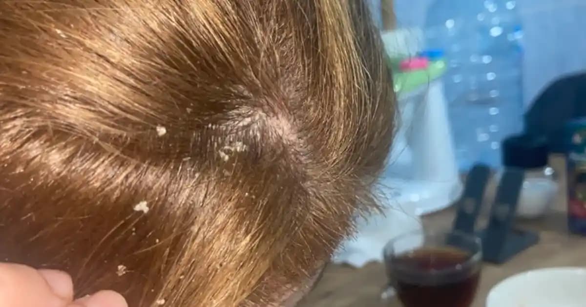 Saçımdan Beyaz Şeyler Dökülmesi Nedenleri ve Etkili Çözüm Yolları