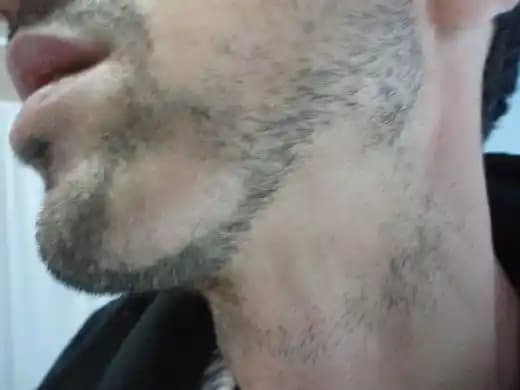 Saçkıran Sakal Nedir, Nedenleri ve Etkili Tedavi Yöntemleri