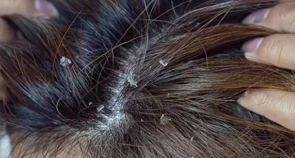 Saçlarda Kabuklanma Nedenleri ve Etkili Çözüm Yöntemleri