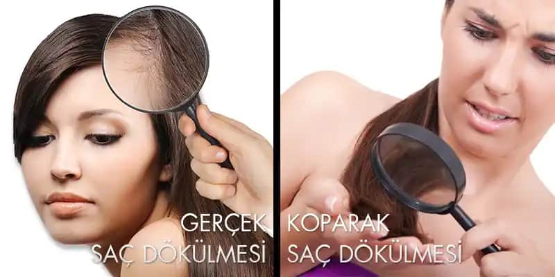 Saçların Dipten Koparak Dökülmesi Nedenleri ve Etkili Önleme Yöntemleri