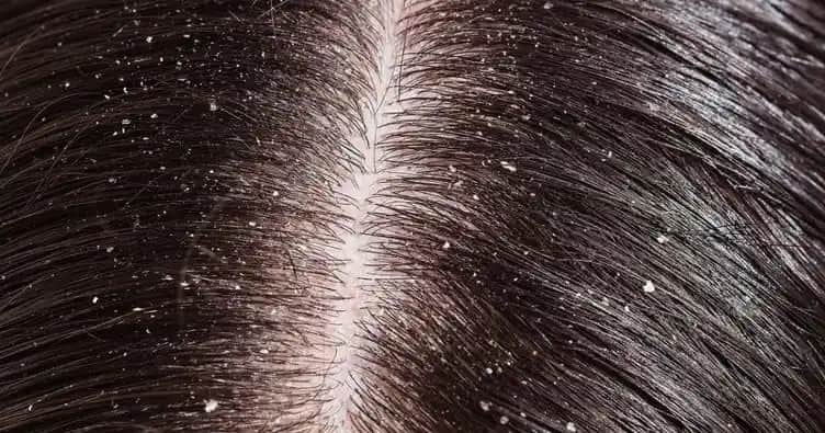 Saçta Aşırı Kepek Nedenleri ve Etkili Önleme Yöntemleri