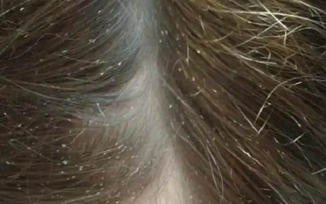 Saçta Bit Resmi Nedir, Belirtileri ve Etkili Mücadele Yöntemleri Hakkında Bilgi