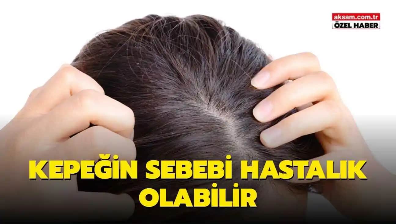 Saçta Çok Kepek Olmasının Nedenleri Belirtileri ve Etkili Çözüm Yöntemleri