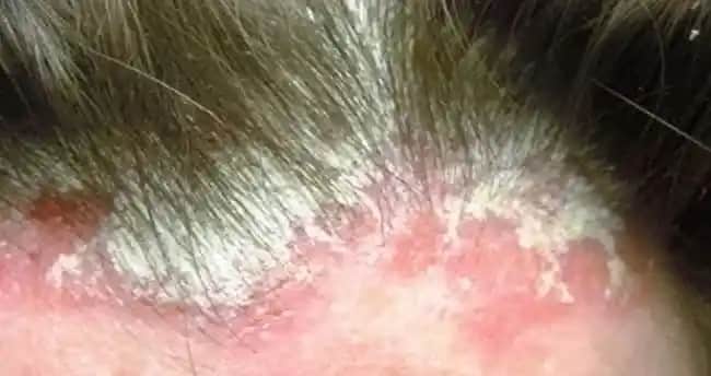 Saçta Dermatitle Mücadelede Güncel Yaklaşımlar ve Etkili Bakım Yöntemleri