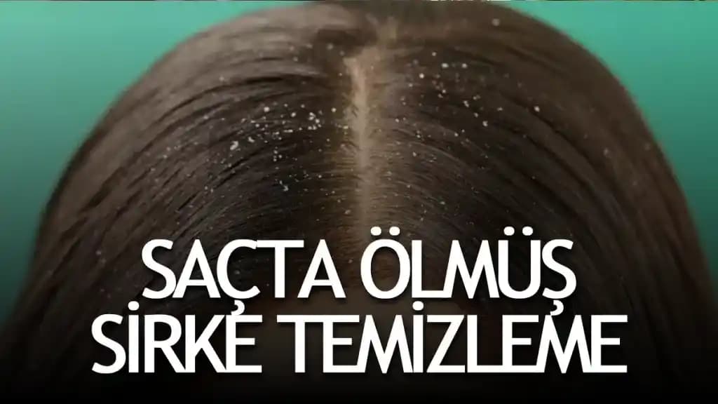 Saçta Ölüm Sirke Durumu: Nedenleri, Belirtileri ve Etkili Çözüm Yolları