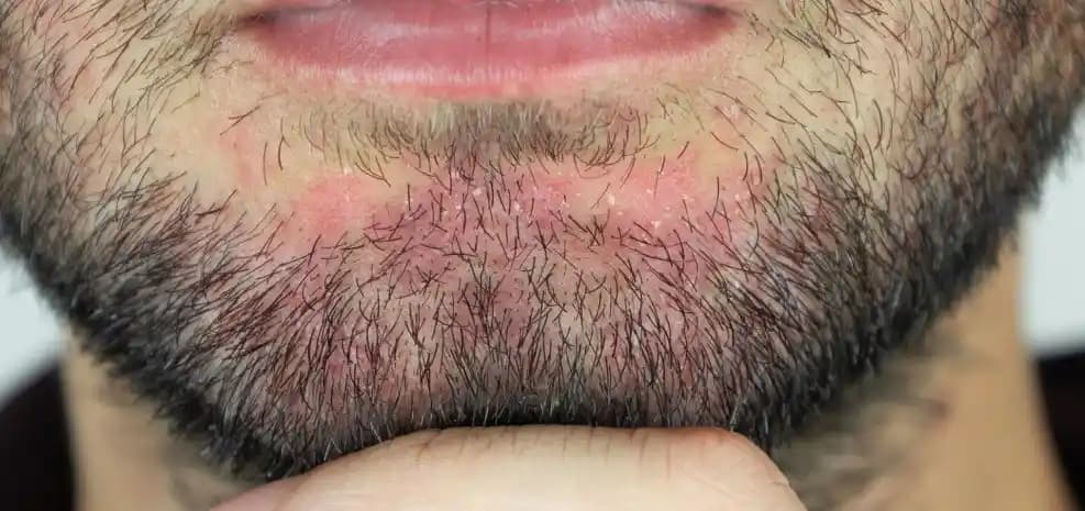 Sakal Kepeklenmesinin Nedenleri ve Etkili Bakım Yöntemleri