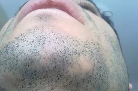 Sakal Kıran Belirtileri ve Doğru Bakım Yöntemleri Hakkında Kapsamlı Rehber