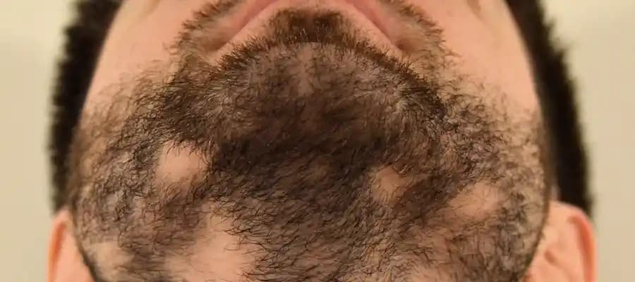 Sakal Kıran ve Sakal Bakımında Dikkat Edilmesi Gerekenler ve Çözüm Yolları