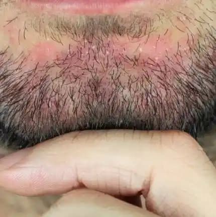 Sakal ve Yüzde Seboreik Dermatitin Nedenleri Belirtileri ve Etkili Bakım Yöntemleri