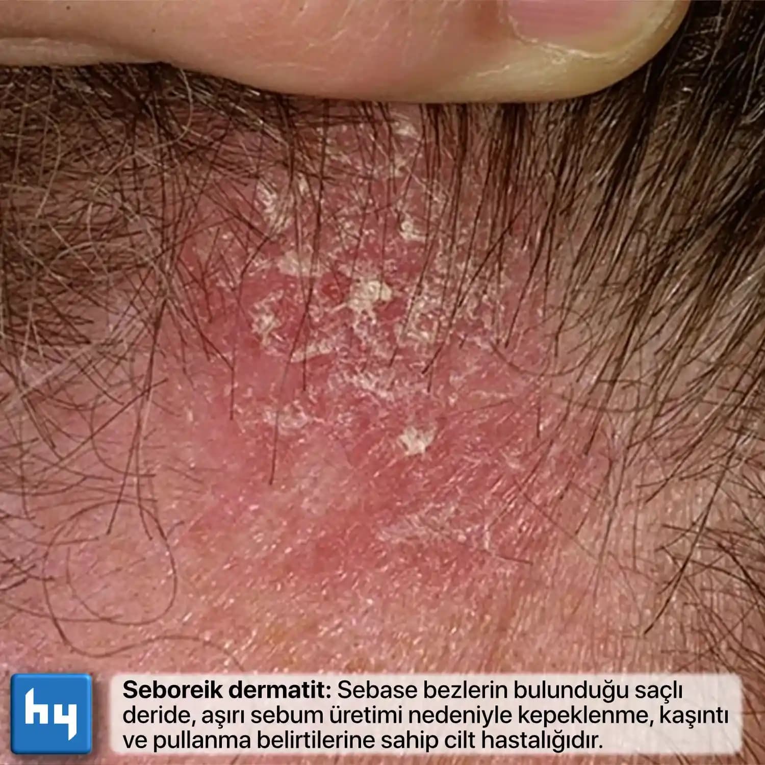 Seboreik dermatit ve beslenme: sağlıklı cilt için bilinçli yaklaşımlar