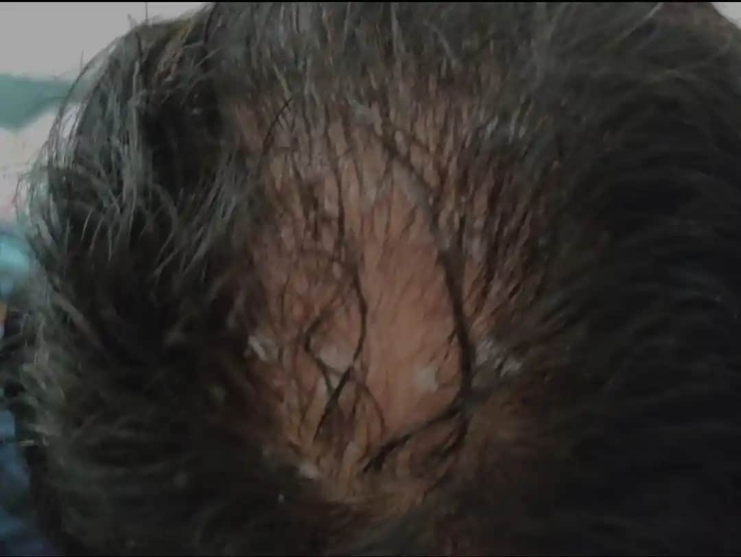 Seboreik Dermatitle İlgili Saç Dökülmesi ve Yeniden Saç Çıkma Yöntemleri