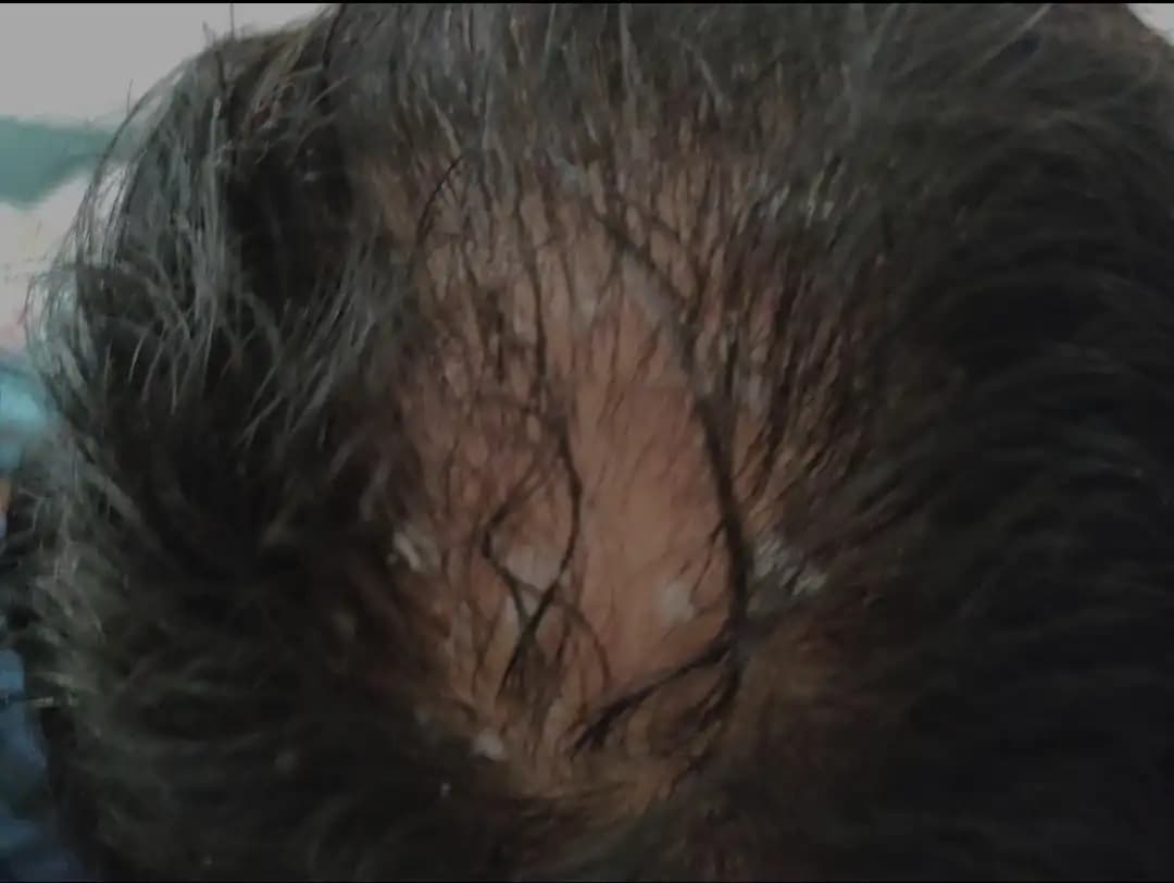 Seboreik Dermatitle İlgili Saç Dökülmesi ve Yeniden Saç Çıkma Yöntemleri