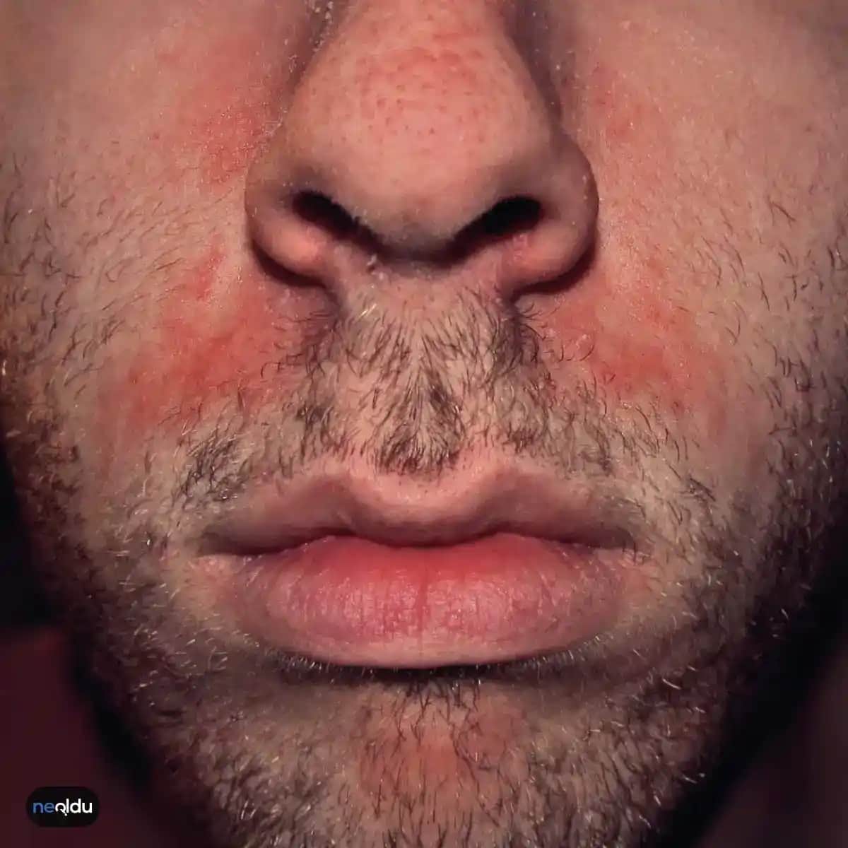 Seboreik Egzama ile Mücadele ve Cilt Sağlığını Koruma Yöntemleri