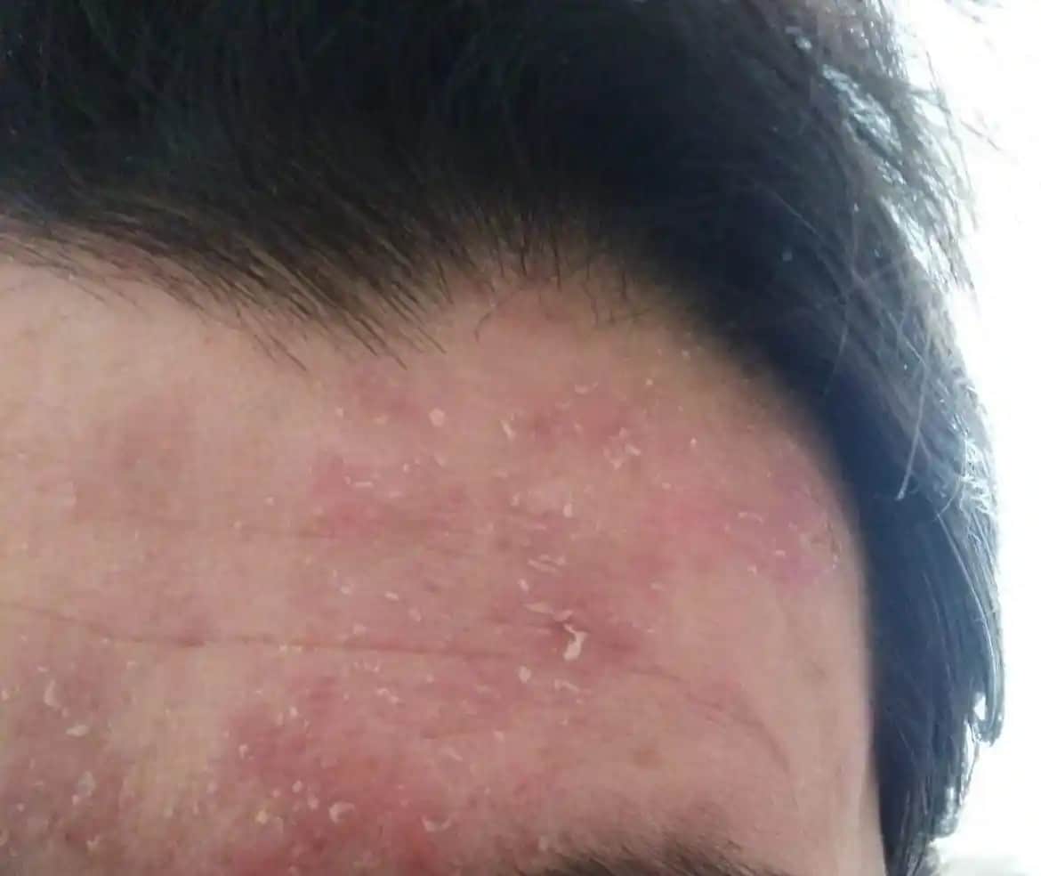 Seboreik Egzema ve Kozmetik Bakım Rehberi: Belirtiler, Ürün Seçimi ve Bakım İpuçları