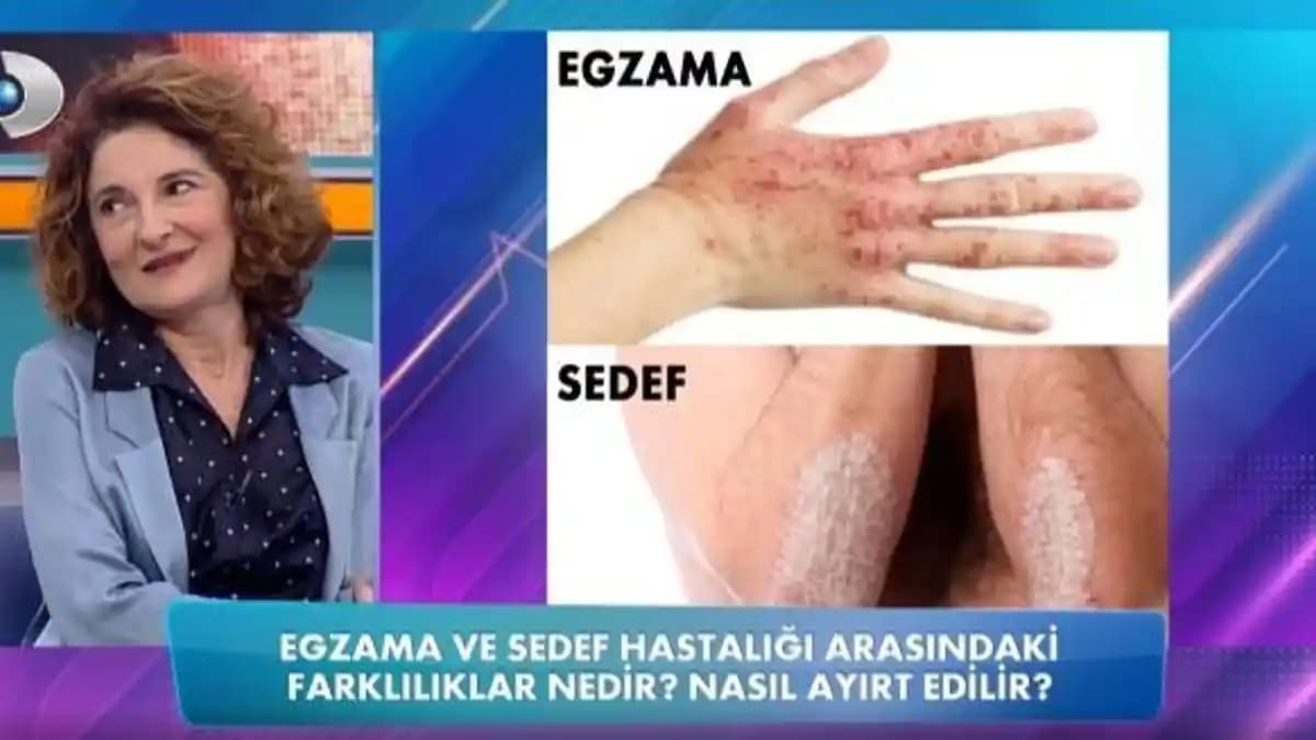 Sedef Hastalığı ve Egzama Arasındaki Farklar ve Doğru Tanı Yöntemleri