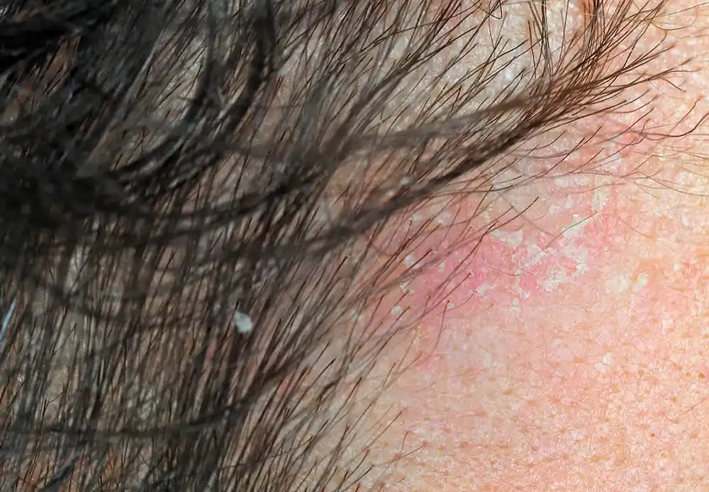 Sedef Hastalığı ve Saç Dökülmesi: Belirtiler, Riskler ve Korunma Yolları