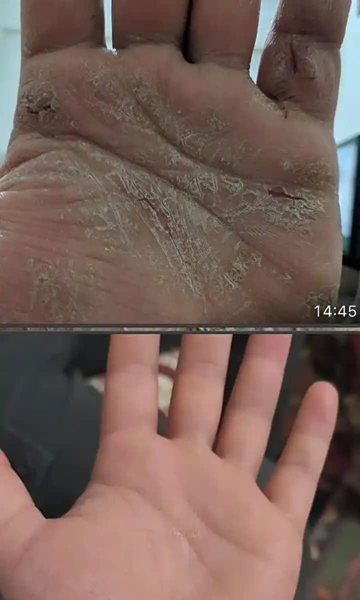 Sedef Hastalığına Karşı Doğal ve Etkili Çözüm Yöntemleri ve Cilt Sağlığını Koruma İpuçları