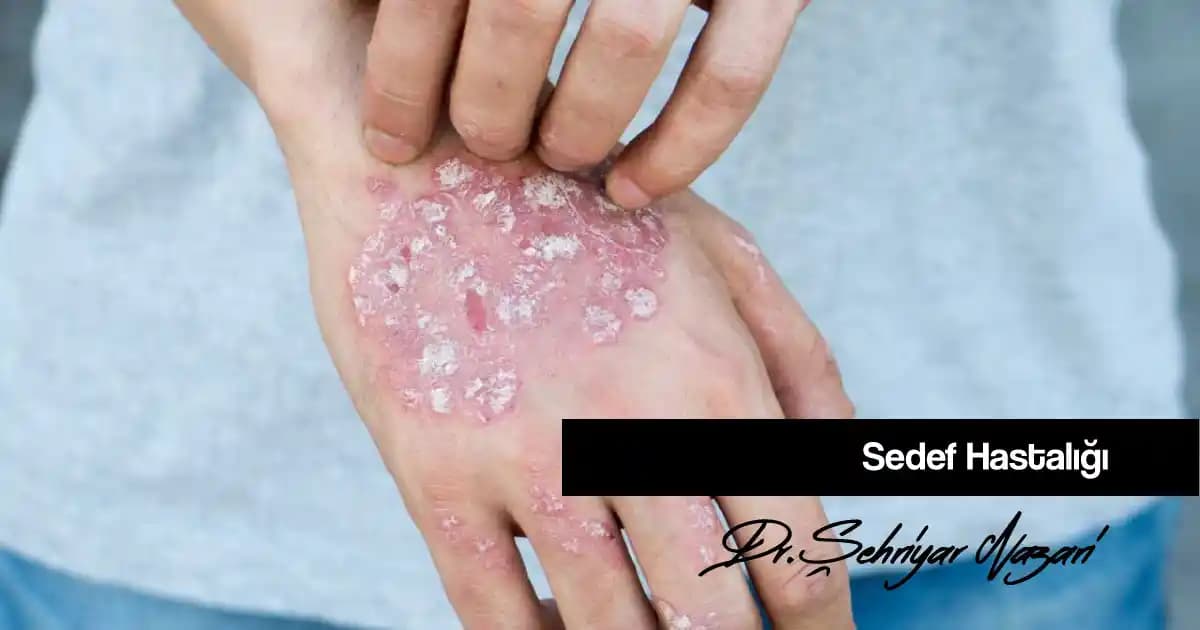 Sedef Hastalığında Kaşıntı ve Kozmetik Ürünlerin Rolü: Doğru Bakım İçin Öneriler