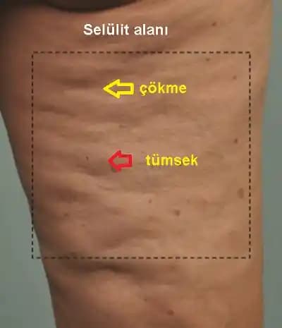 Selülit Nedir, Nedenleri ve Etkili Çözüm Yöntemleri Kozmetik ve Doğal Yaklaşımlar