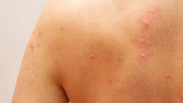 Sırt Bölgesinde Ağrılı Sivilceler: Nedenleri, Tedavi ve Önleme Yöntemleri