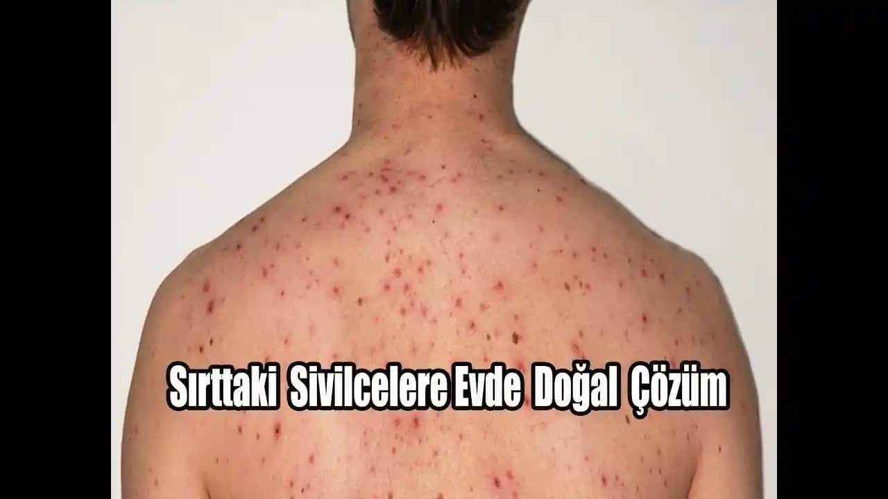 Sırt Sivilcelerine Kalıcı ve Etkili Çözüm Yolları Cilt Bakımında Uzman Tavsiyeleriyle
