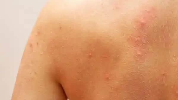 Sırtta Büyük Sivilceler: Nedenleri, Tedavi Yöntemleri ve Önleme İpuçları