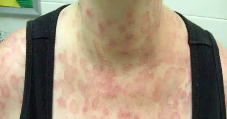 Sırtta Gül Hastalığı Nedir, Belirtileri ve Tedavi Yöntemleri Hakkında Kapsamlı Bilgi