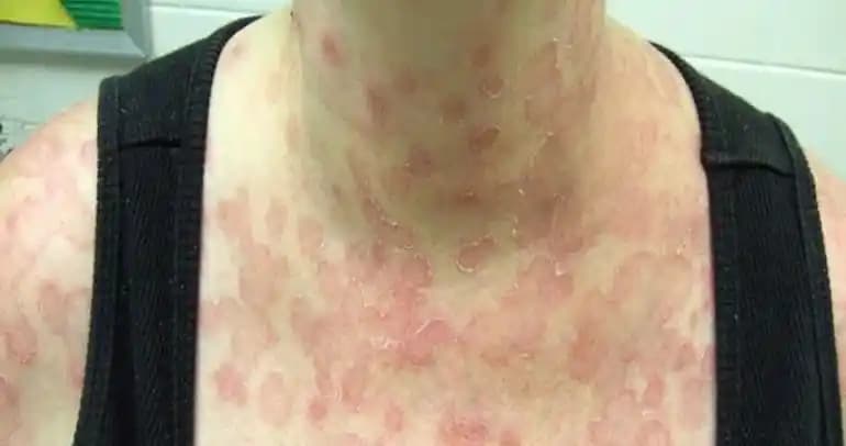 Sırtta Gül Hastalığı Nedir, Belirtileri ve Tedavi Yöntemleri Hakkında Kapsamlı Bilgi