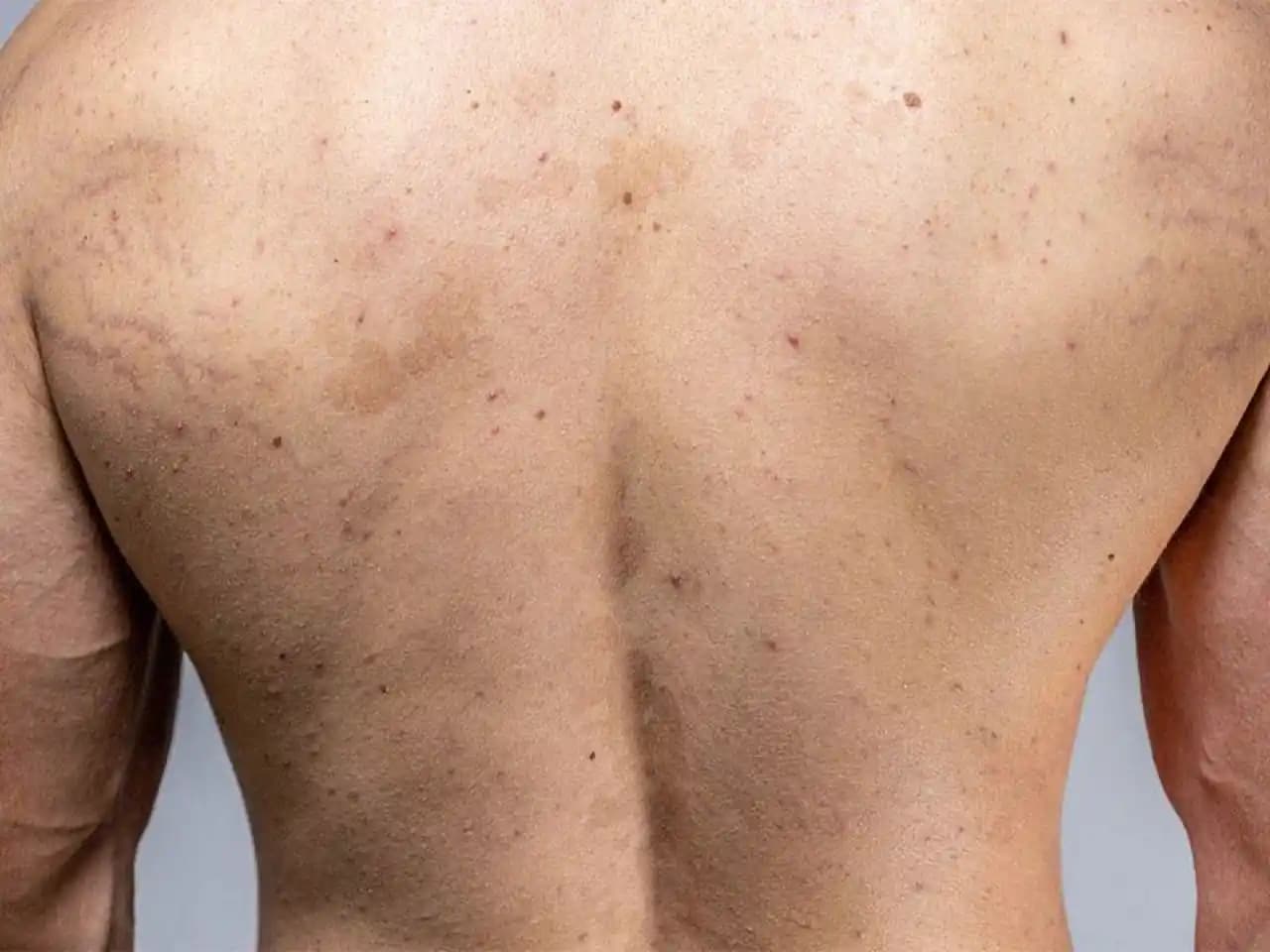 Sırtta Yara ve Sivilce Nedenleri ile Çözüm Yolları Hakkında Detaylı Bilgi