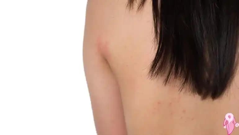 Sırttaki Lekelerin Nedenleri ve Cilt Sağlığını Koruma Yöntemleri