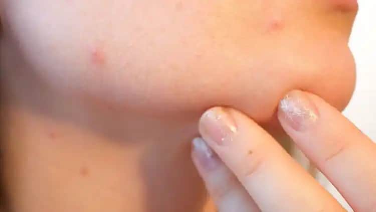 Şiş Sivilce Nasıl İner En Etkili Yöntemler ve Cilt Bakımı İpuçları