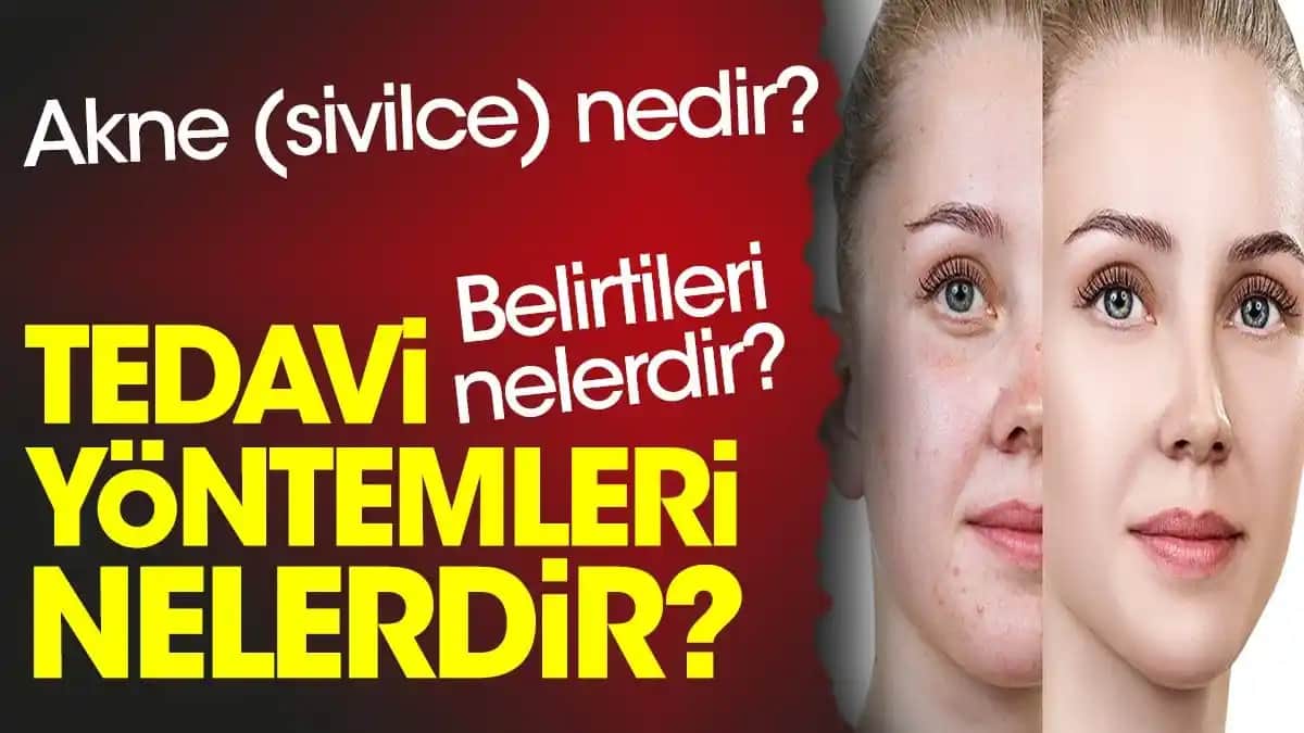 Sivilce Azaltma Rehberi: Cildinizi Kontrol Altına Almanın Etkili Yolları