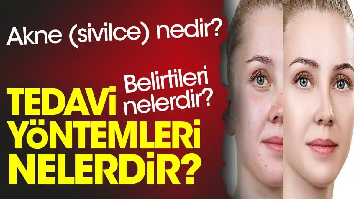 Sivilce Azaltma Rehberi: Cildinizi Kontrol Altına Almanın Etkili Yolları