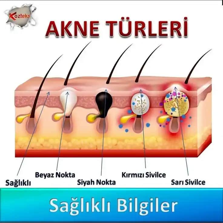 Sivilce Çeşitleri ve Doğru Bakım Yöntemleri Hakkında Kapsamlı Bilgi