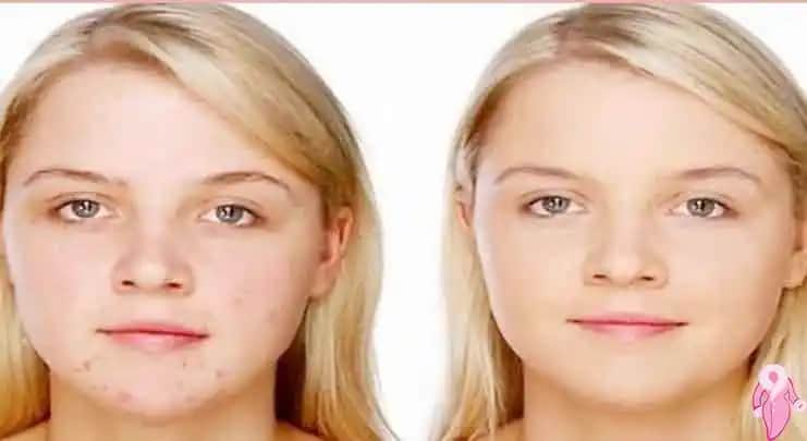 Sivilce Çözümü ve Sağlıklı Parlak Bir Cilt İçin Güncel Rehber