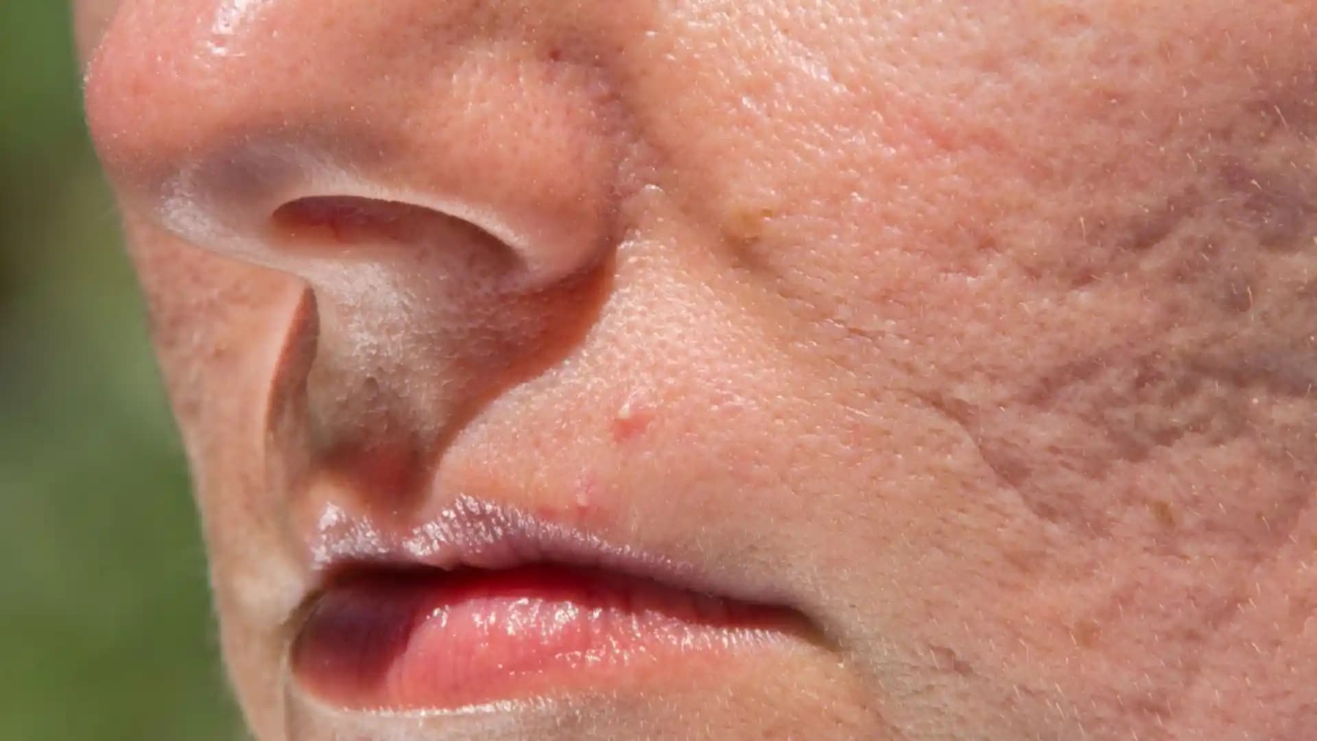 Sivilce Çukurlarıyla Mücadelede Güncel ve Etkili Çözüm Yöntemleri