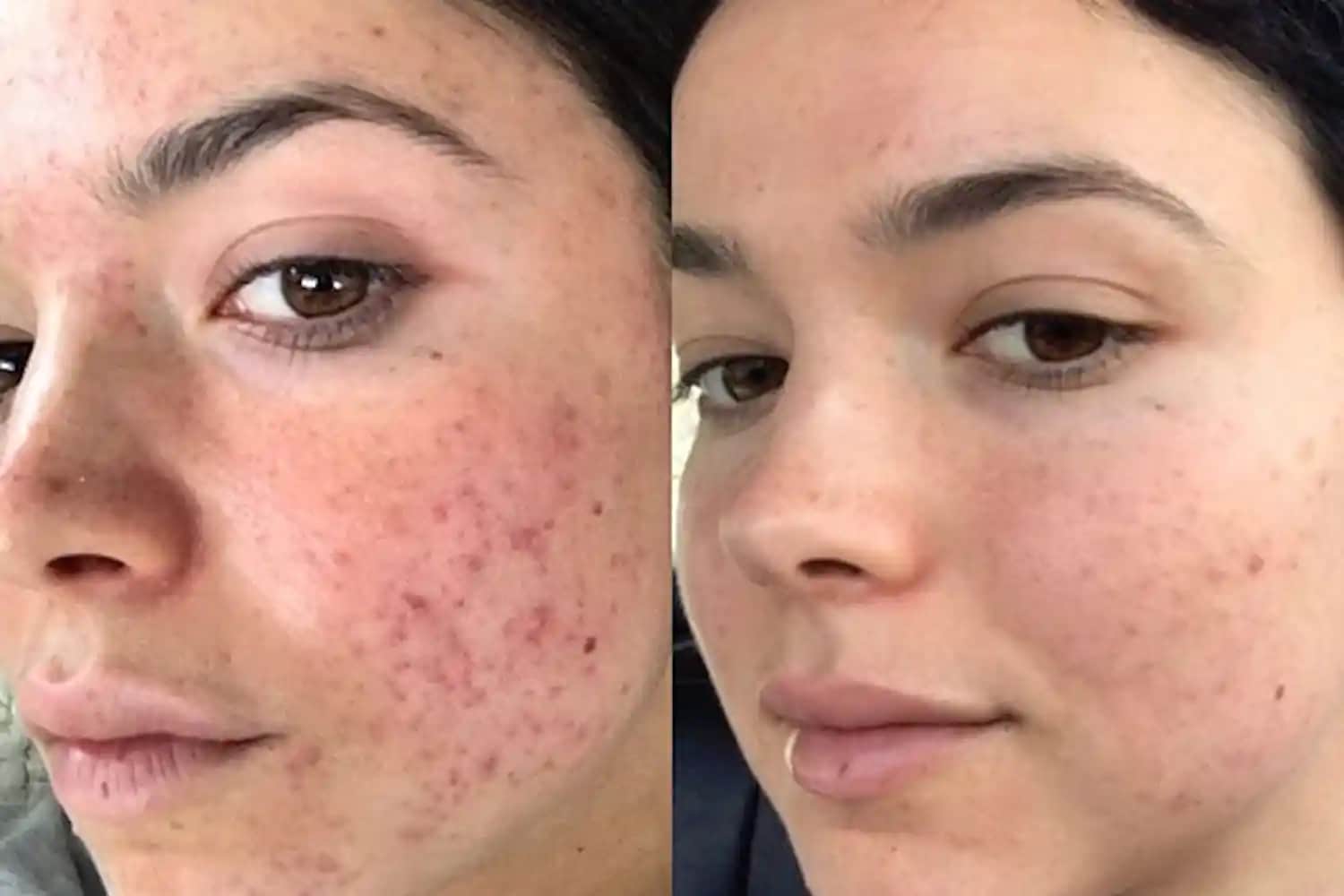 Sivilce İzi Lazer Tedavisi: Cilt Yenileme ve Güzellik İçin Etkili Yöntemler