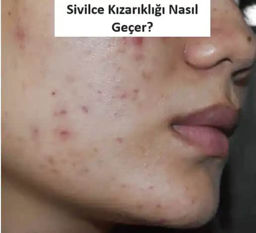Sivilce İzi ve Kızarıklıkların Giderilmesi İçin Etkili Yöntemler ve Cilt Sağlığı Rehberi