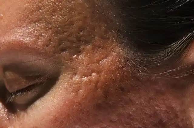 Sivilce İzleri Nasıl Giderilir ve Cilt Sağlığını Yenileme Yöntemleri