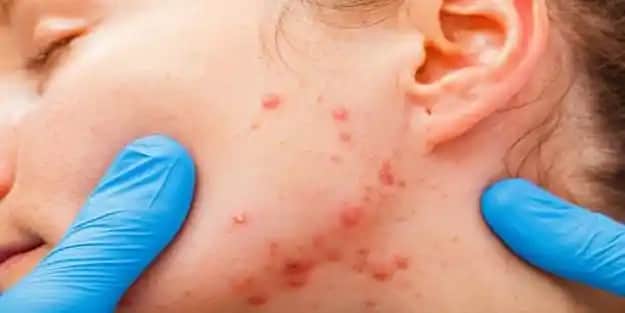 Sivilce İzleri Neden Oluşur ve Etkili Tedavi Yöntemleri Nelerdir