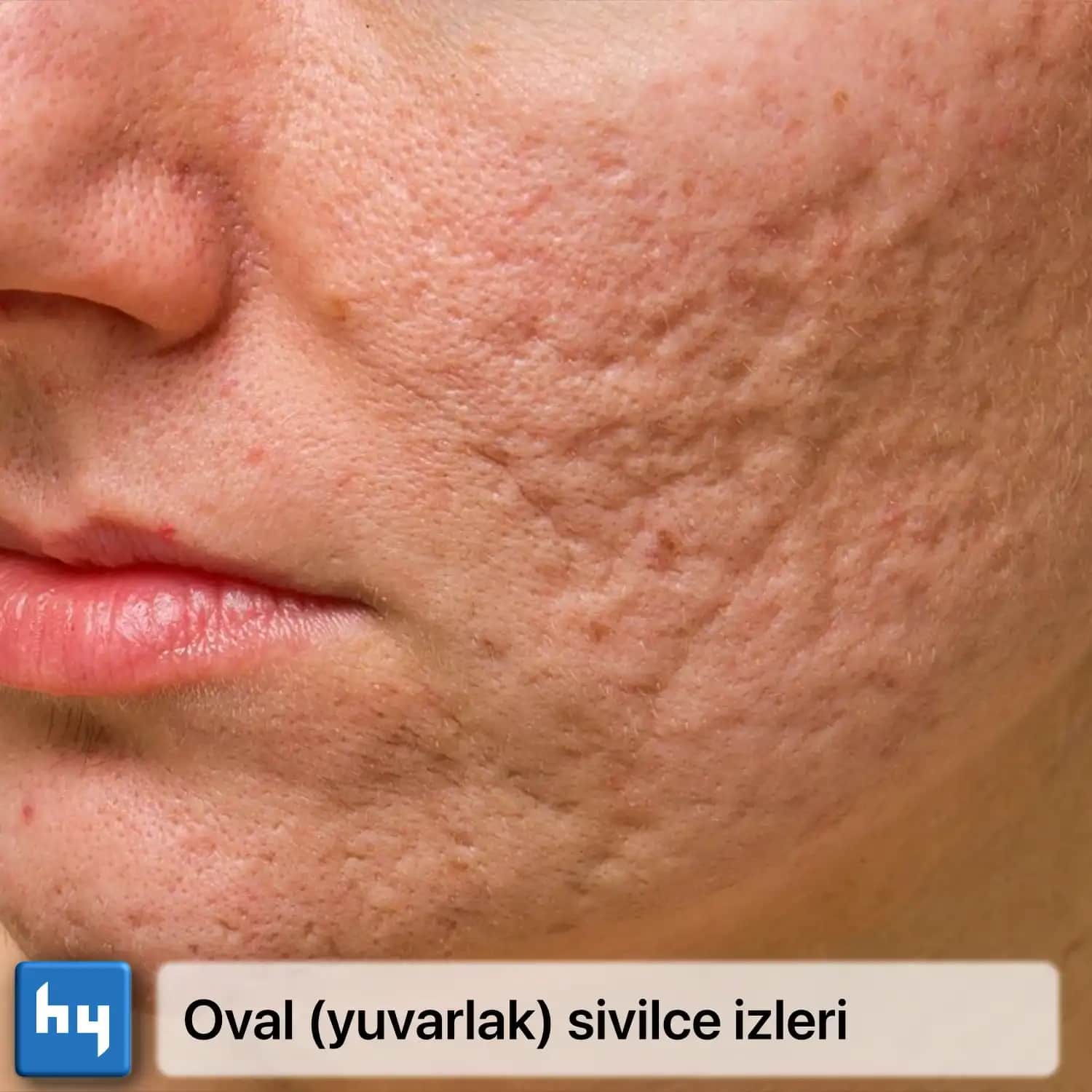 Sivilce İzleriyle Mücadelede Güncel Tedavi Yöntemleri ve Doğal Çözümler