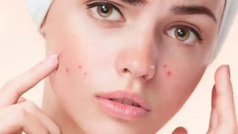 Sivilce Kaç Yaşında Geçer ve Doğru Cilt Bakımı Yöntemleri