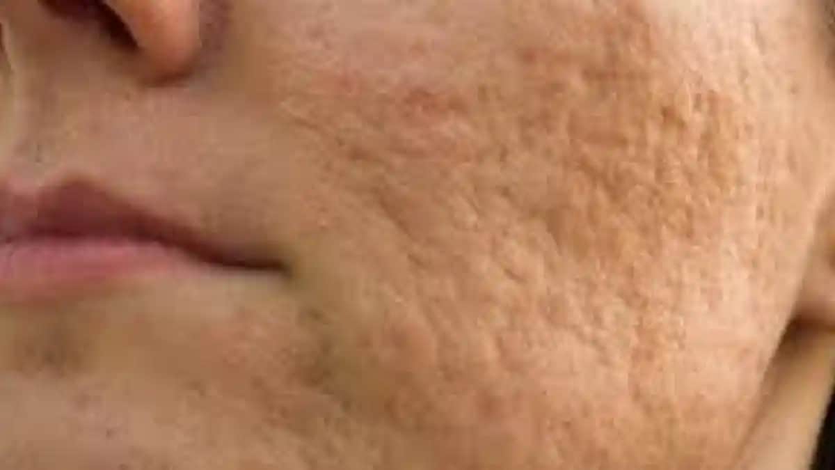 Sivilce Lekeleri Nasıl Geçer Cilt Sağlığı İçin Etkili Yöntemler ve Doğal Çözümler