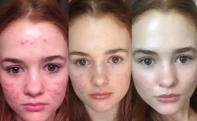 Sivilce Ne Zaman Biter? Doğru Yaklaşımlar ve Sabırla Cilt Sağlığını Koruma