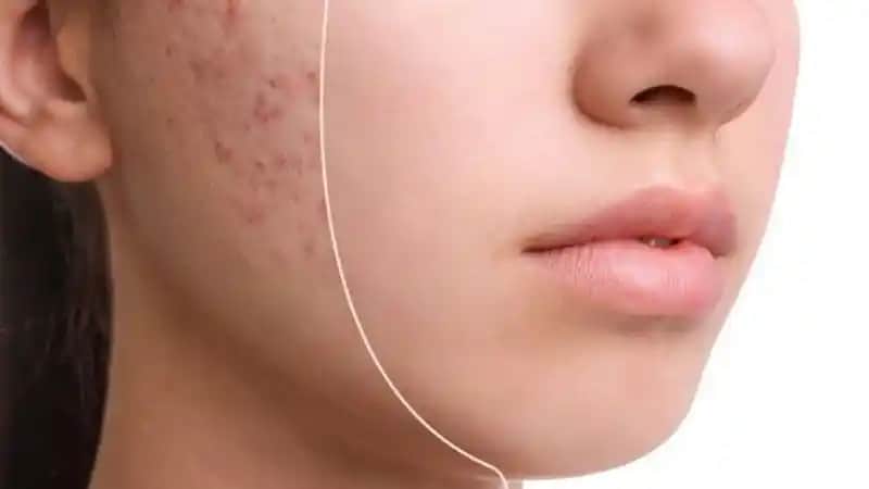 Sivilce Ne Zaman Geçer ve Hızlandırıcı Yöntemler Nelerdir