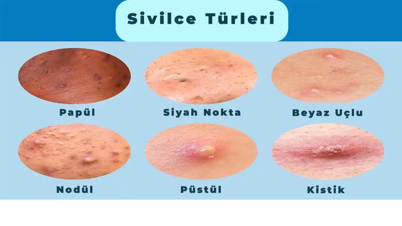 Sivilce Nedenleri ve Kalıcı Çözüm Yolları Hakkında Detaylı Bilgi